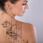 Tattooentfernung